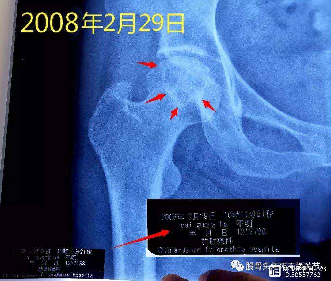 泰安人工骨头医保报销多少(人工骨头医保报销多少比例)